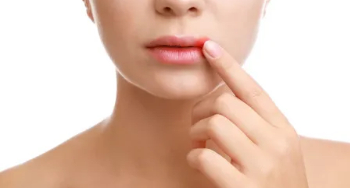 Herpes labial.jpg