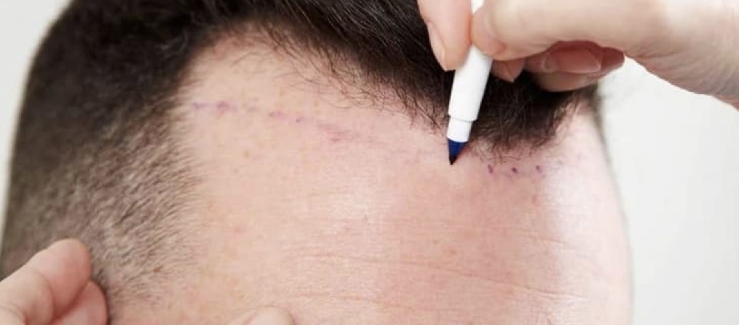 Transplante capilar.jpg